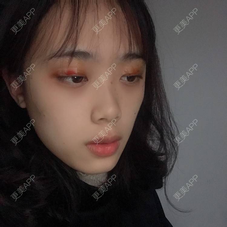 更美 - 王艳 医生的双眼皮经验 | 双眼皮 | 嘉兴