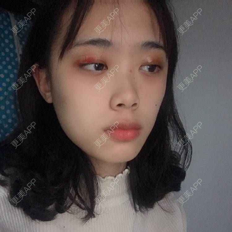 更美 - 王艳 医生的双眼皮经验 | 双眼皮 | 嘉兴