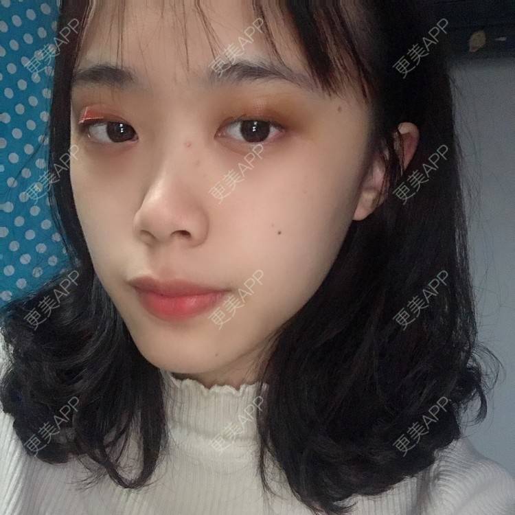 更美 - 王艳 医生的双眼皮经验 | 双眼皮 | 嘉兴