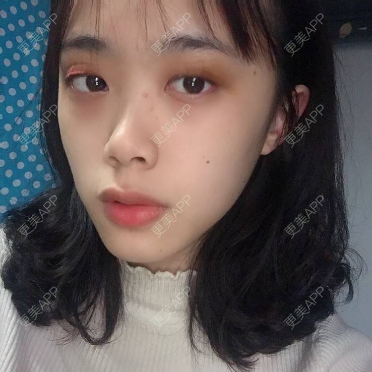 更美 - 王艳 医生的双眼皮经验 | 双眼皮 | 嘉兴
