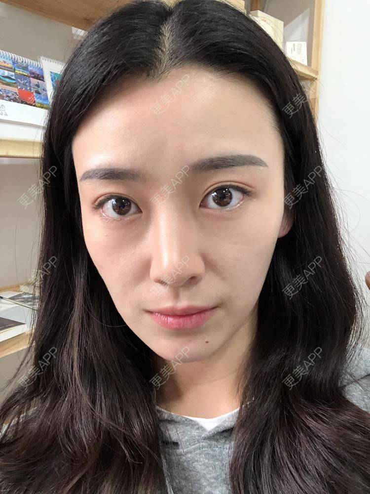 更美 - 范萌知 医生的隆鼻经验 | 隆鼻 | 嘉兴