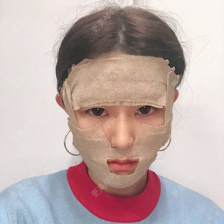 更美 - 李燕飞 医生的自体脂肪面部填充经验 | 自体脂肪面部填充