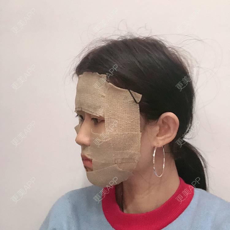 更美 - 李燕飞 医生的自体脂肪面部填充经验 | 自体脂肪面部填充