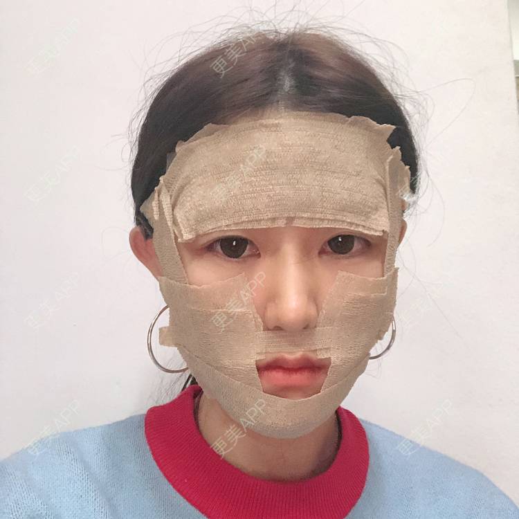 更美 - 李燕飞 医生的自体脂肪面部填充经验 | 自体脂肪面部填充