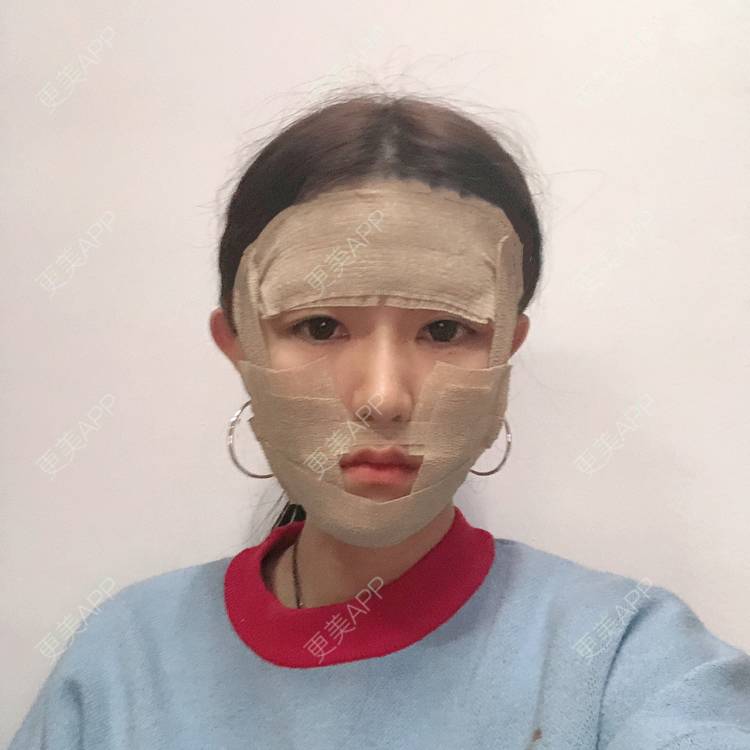 更美 - 李燕飞 医生的自体脂肪面部填充经验 | 自体脂肪面部填充