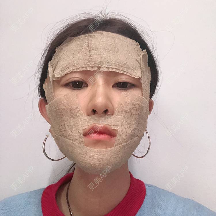 更美 - 李燕飞 医生的自体脂肪面部填充经验 | 自体脂肪面部填充