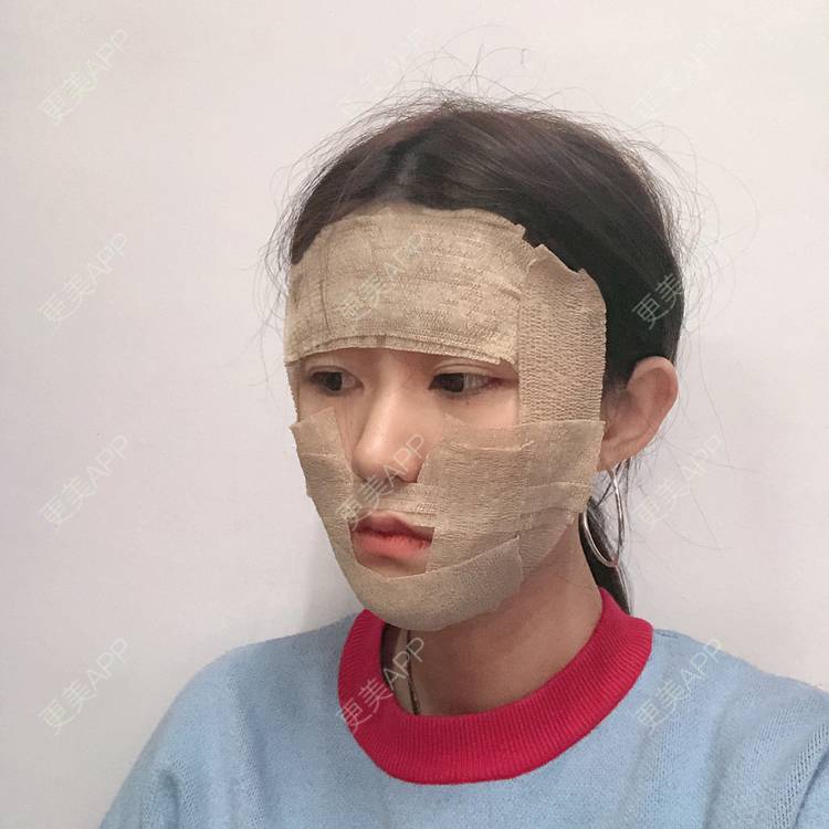 更美 - 李燕飞 医生的自体脂肪面部填充经验 | 自体脂肪面部填充