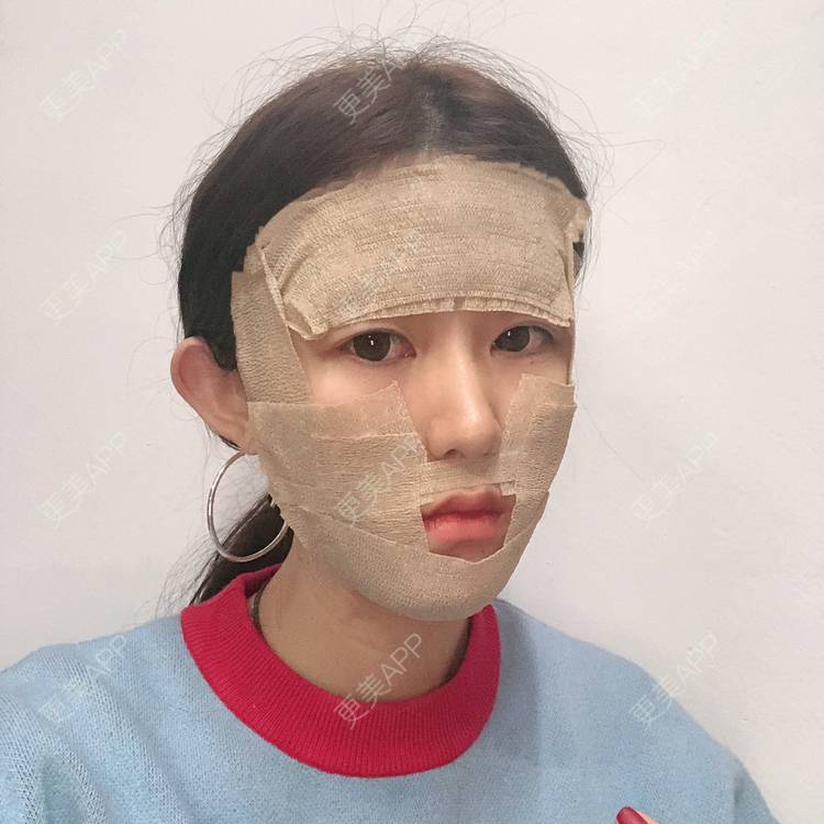 更美 - 李燕飞 医生的自体脂肪面部填充经验 | 自体脂肪面部填充