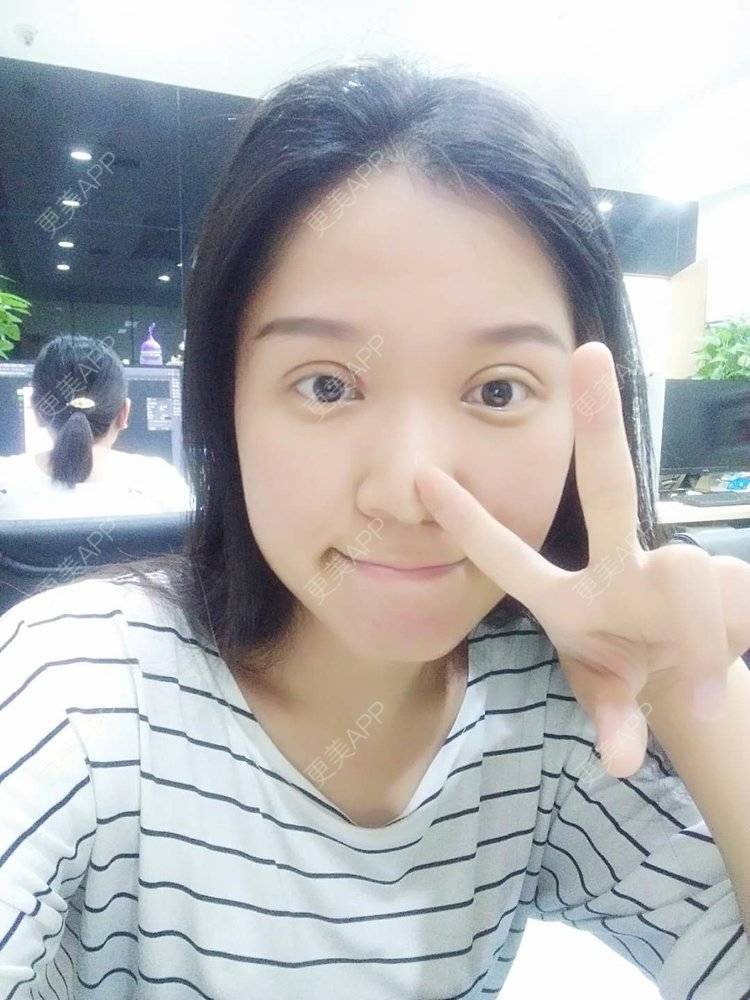 更美 - 更美用户5Pz3SpoBlS的果酸焕肤经验 | 济南 | 果酸焕肤