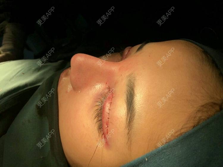 更美 - 更美用户crt1w6PLR8的鼻部多项经验 | 丰胸（隆胸） | 眼部综合 | 激光脱毛 | 下颌角 | 假体隆胸 | 除皱瘦脸 | 鼻部多项 | 淡化皱纹 | PRP自体血清美肤 | 玻尿酸 | 鼻部综合 | 上海