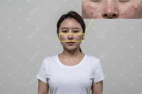更美 - 重庆美莱整形美容医院的红蓝光清痘经验 | 红蓝光清痘