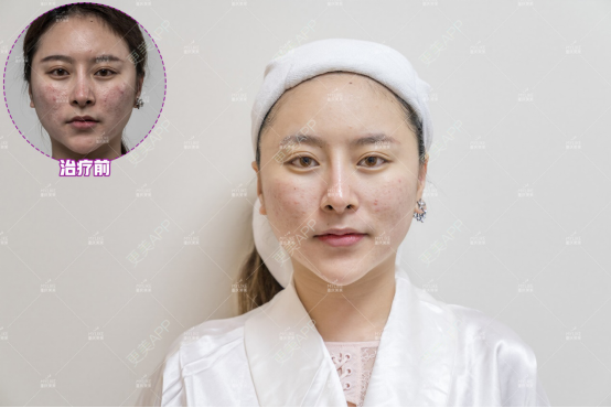 更美 - 重庆美莱整形美容医院的红蓝光清痘经验 | 红蓝光清痘