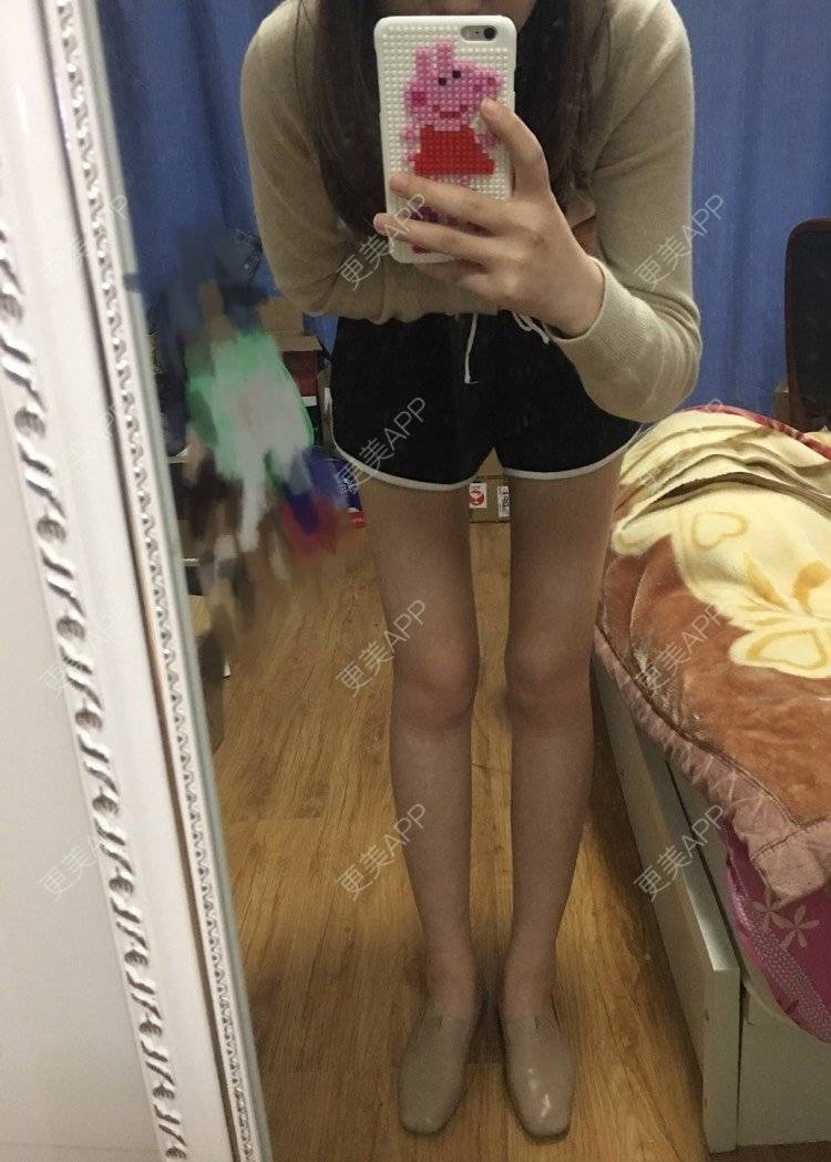 仙女儿爱吃鸡的吸脂瘦大腿日记