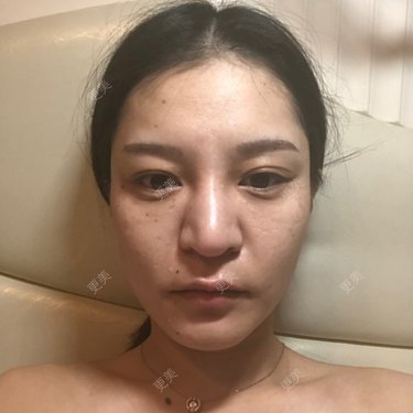 硅胶隆鼻