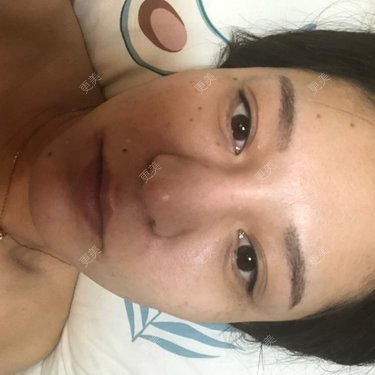 硅胶隆鼻
