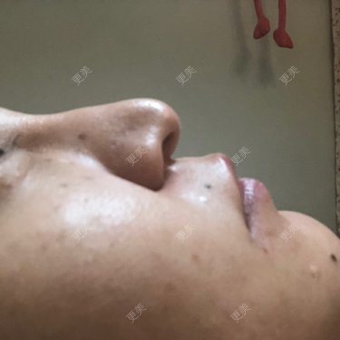 硅胶隆鼻