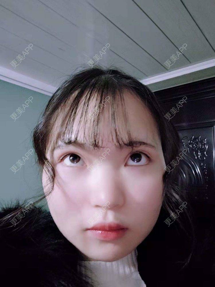 更美 - 刘晋军 医生的鼻部硅胶假体取出经验 | 鼻部修复 | 鼻形态修复 | 鼻部硅胶假体取出 | 南京