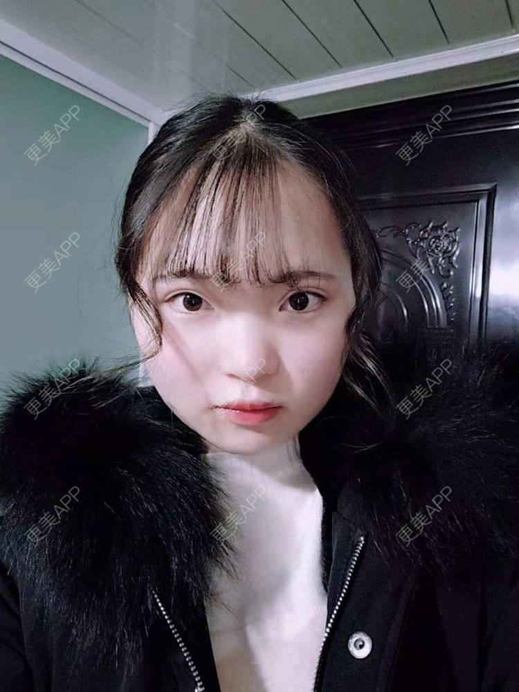 更美 - 刘晋军 医生的鼻部硅胶假体取出经验 | 鼻部修复 | 鼻形态修复 | 鼻部硅胶假体取出 | 南京