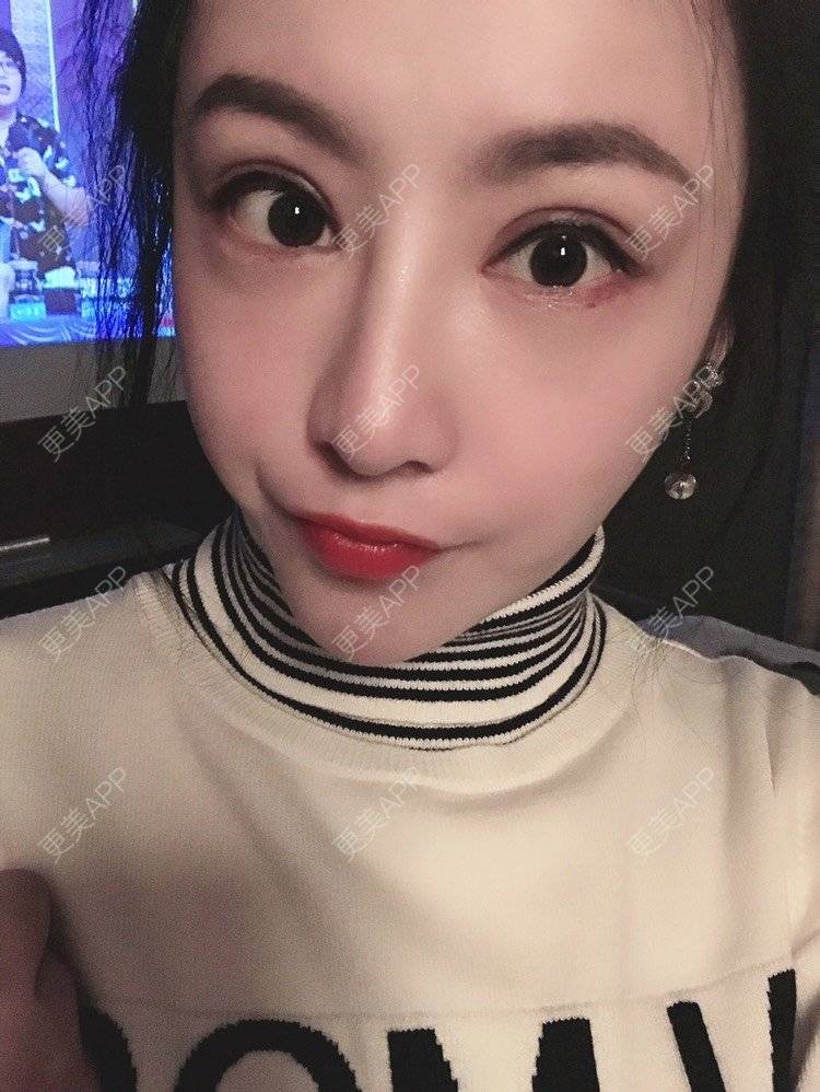 更美 - 卡门小妖精，的玻尿酸卧蚕经验 | 玻尿酸卧蚕 | 重庆 | 自体脂肪丰卧蚕 | 真皮丰卧蚕 | 双眼皮修复 | 眼部多项