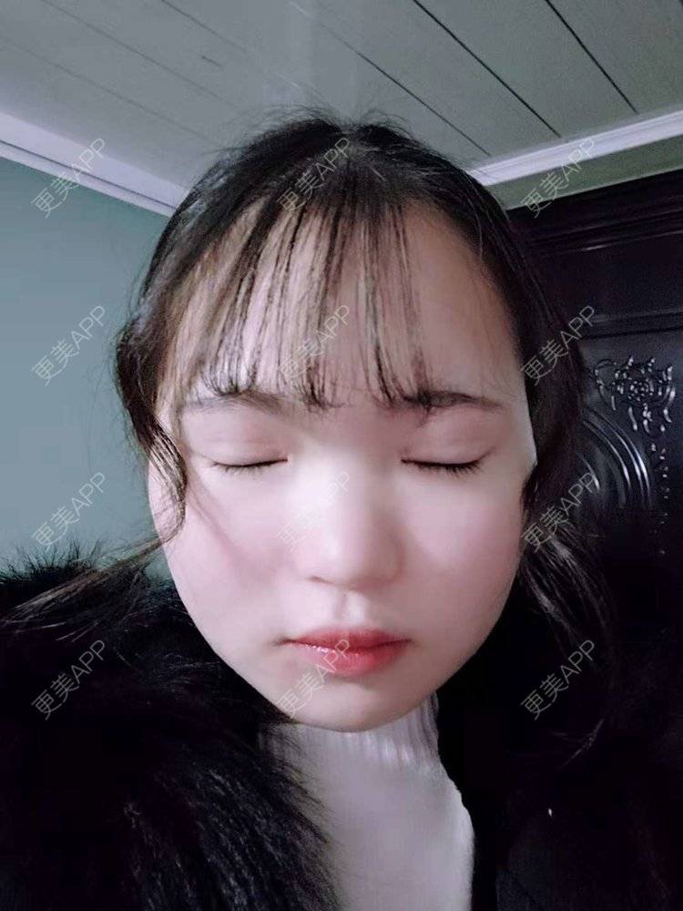 更美 - 刘晋军 医生的鼻部硅胶假体取出经验 | 鼻部修复 | 鼻形态修复 | 鼻部硅胶假体取出 | 南京