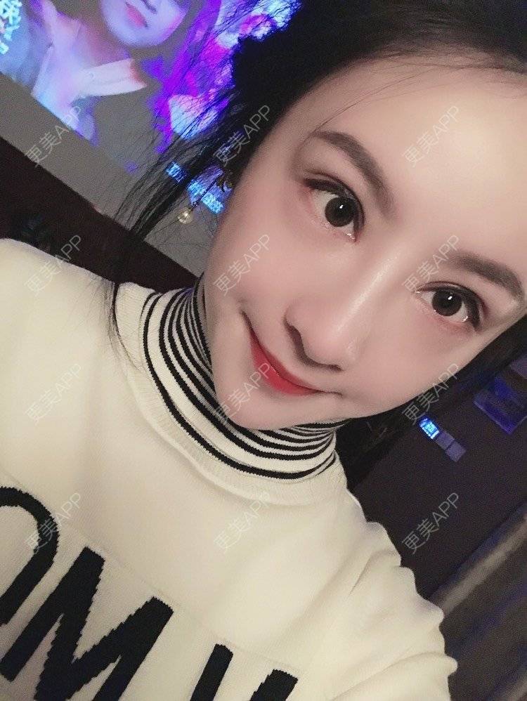 更美 - 卡门小妖精，的玻尿酸卧蚕经验 | 玻尿酸卧蚕 | 重庆 | 自体脂肪丰卧蚕 | 真皮丰卧蚕 | 双眼皮修复 | 眼部多项