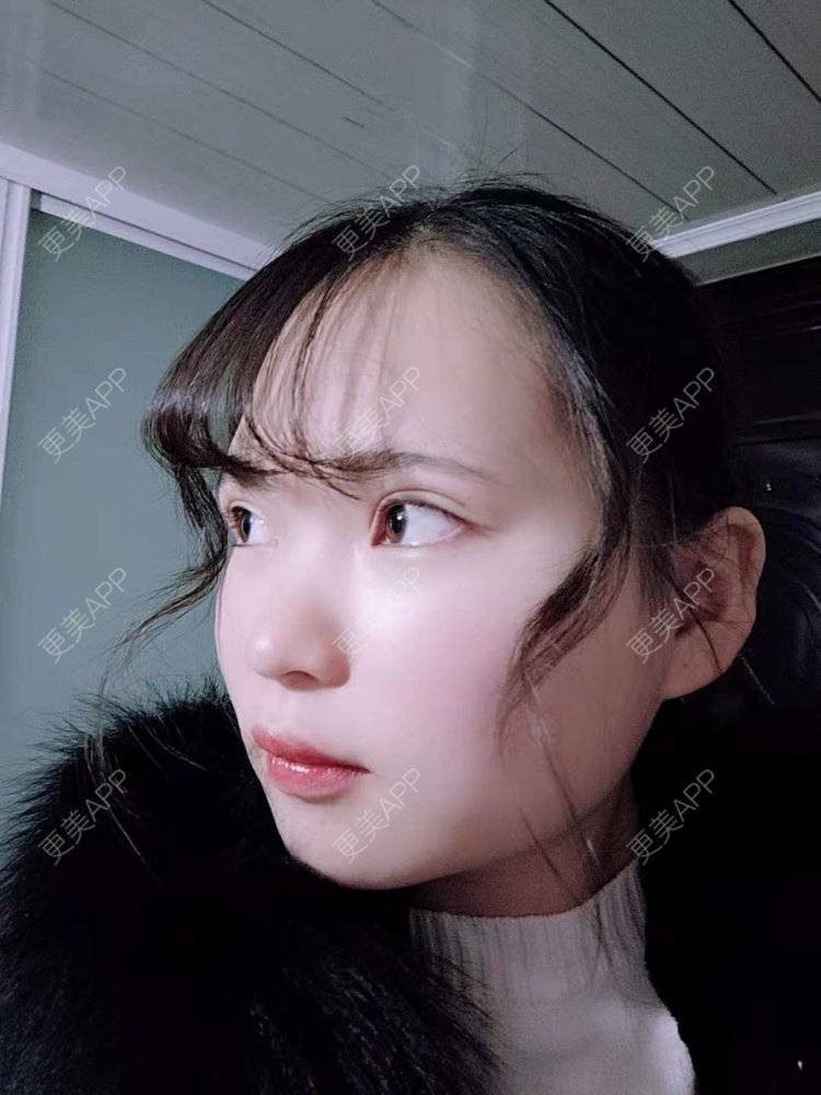 更美 - 刘晋军 医生的鼻部硅胶假体取出经验 | 鼻部修复 | 鼻形态修复 | 鼻部硅胶假体取出 | 南京