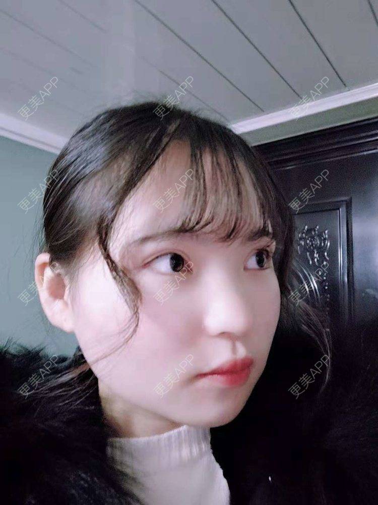 更美 - 刘晋军 医生的鼻部硅胶假体取出经验 | 鼻部修复 | 鼻形态修复 | 鼻部硅胶假体取出 | 南京