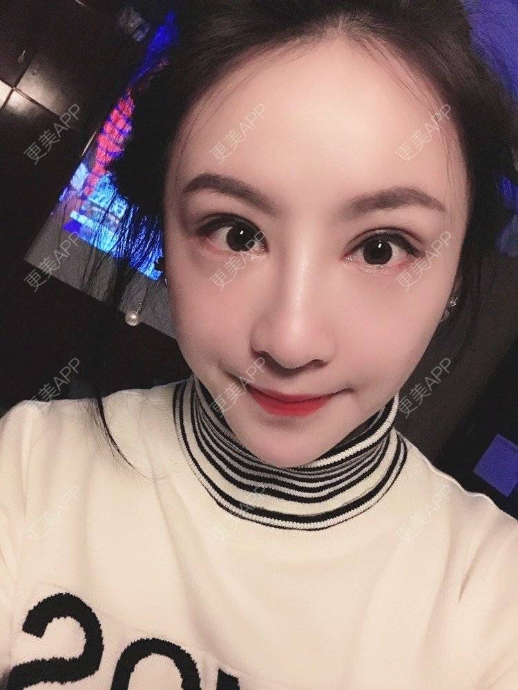 更美 - 卡门小妖精，的玻尿酸卧蚕经验 | 玻尿酸卧蚕 | 重庆 | 自体脂肪丰卧蚕 | 真皮丰卧蚕 | 双眼皮修复 | 眼部多项