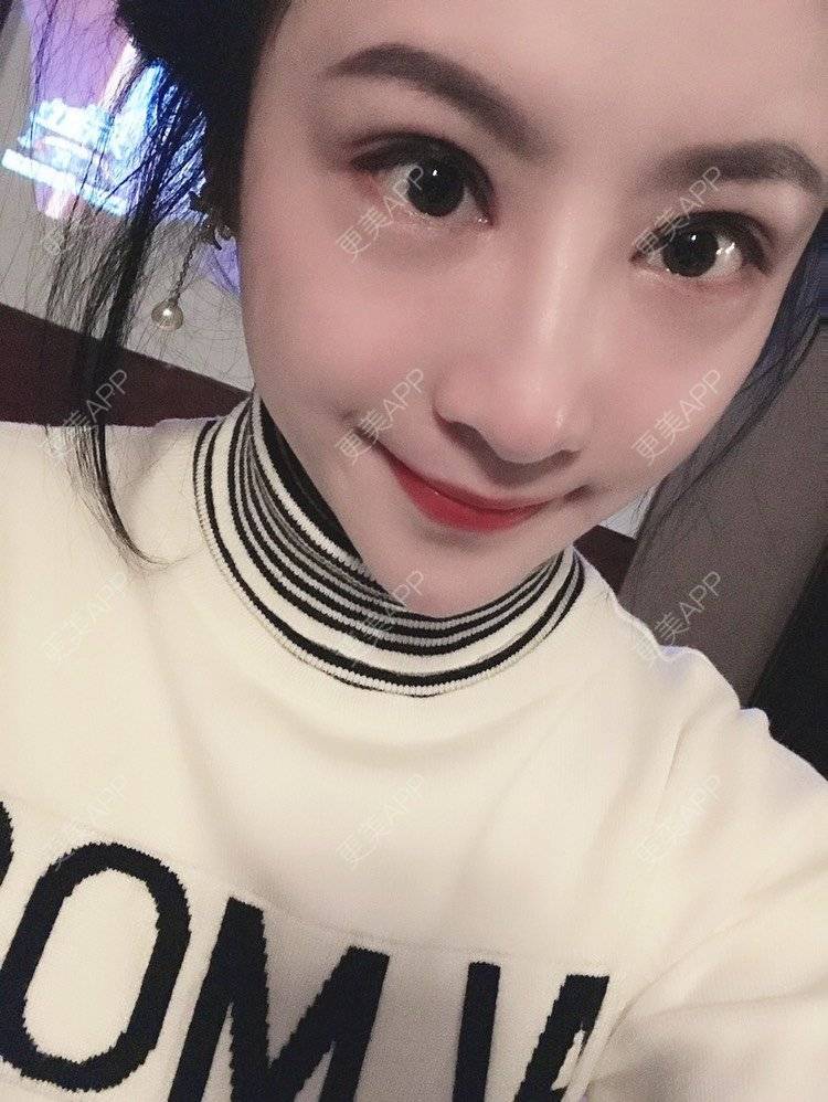 更美 - 卡门小妖精，的玻尿酸卧蚕经验 | 玻尿酸卧蚕 | 重庆 | 自体脂肪丰卧蚕 | 真皮丰卧蚕 | 双眼皮修复 | 眼部多项