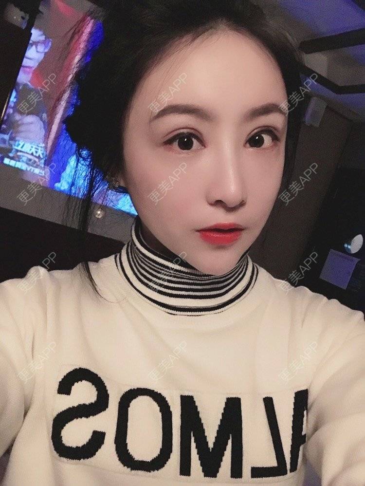 更美 - 卡门小妖精，的玻尿酸卧蚕经验 | 玻尿酸卧蚕 | 重庆 | 自体脂肪丰卧蚕 | 真皮丰卧蚕 | 双眼皮修复 | 眼部多项
