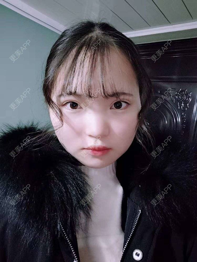 更美 - 刘晋军 医生的鼻部硅胶假体取出经验 | 鼻部修复 | 鼻形态修复 | 鼻部硅胶假体取出 | 南京