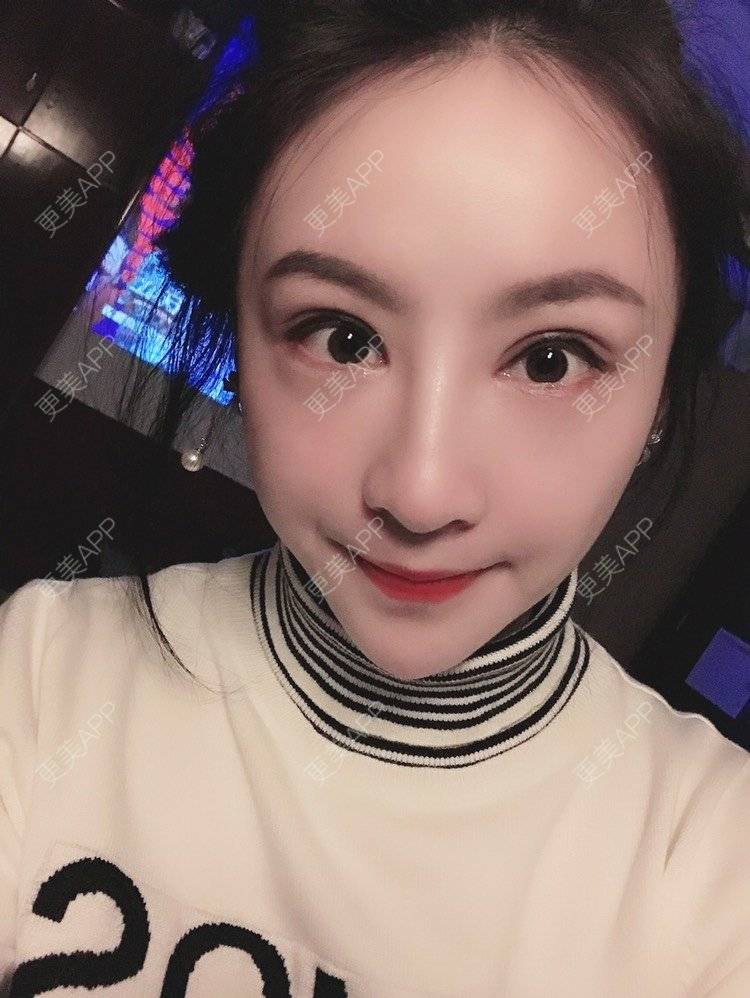 更美 - 卡门小妖精，的玻尿酸卧蚕经验 | 玻尿酸卧蚕 | 重庆 | 自体脂肪丰卧蚕 | 真皮丰卧蚕 | 双眼皮修复 | 眼部多项