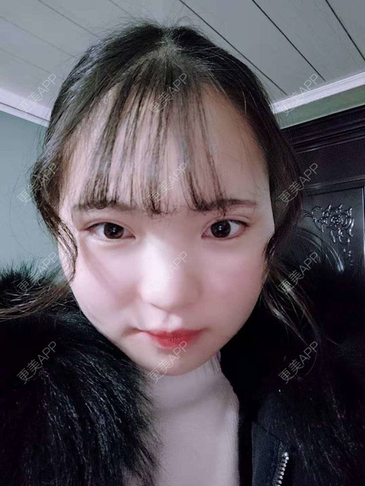 更美 - 刘晋军 医生的鼻部硅胶假体取出经验 | 鼻部修复 | 鼻形态修复 | 鼻部硅胶假体取出 | 南京