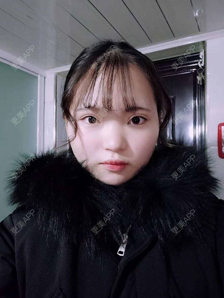 更美 - 刘晋军 医生的鼻部硅胶假体取出经验 | 鼻部修复 | 鼻形态修复 | 鼻部硅胶假体取出 | 南京