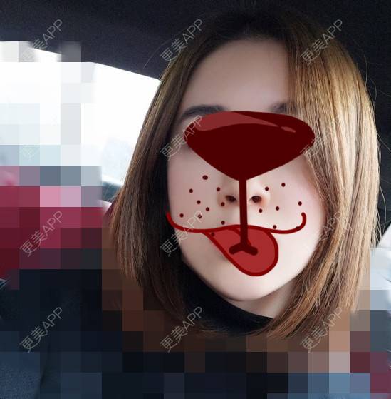 更美 - 更美用户BtHA0pILpQ的半永久纹发际线经验 | 北京 | 半永久纹发际线