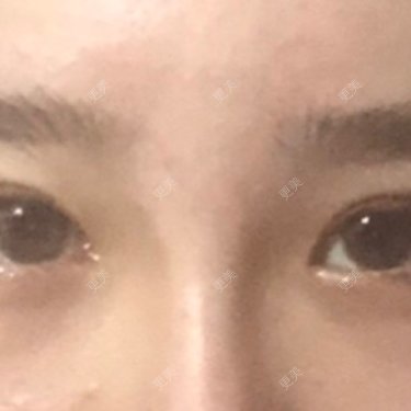 开内眼角