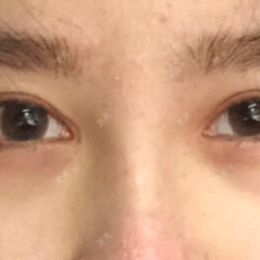 开内眼角
