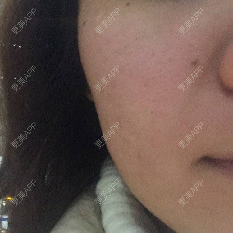 更美 - 朱佩奇的激光淡疤经验 | 丰胸（隆胸） | 隆胸假体取出 | 激光脱毛 | 水光项目 | 双眼皮 | 激光淡疤 | 杭州