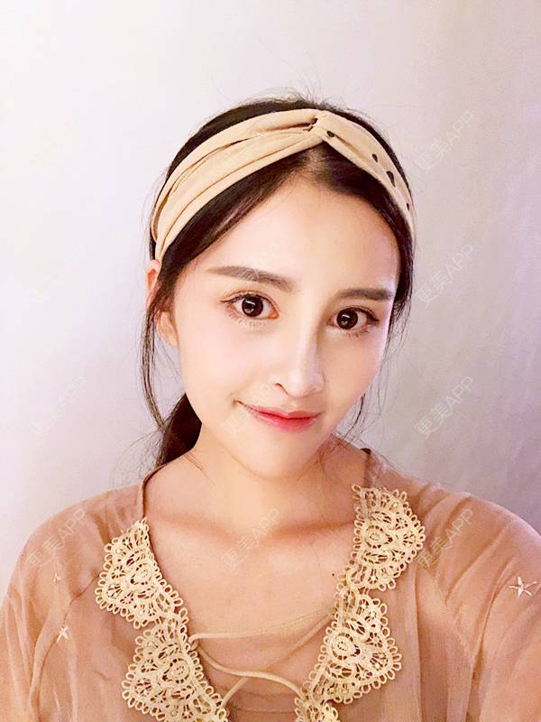 耳软骨隆鼻效果图_更美用户h8edyz8s5h耳软骨隆鼻效果图_术后179天