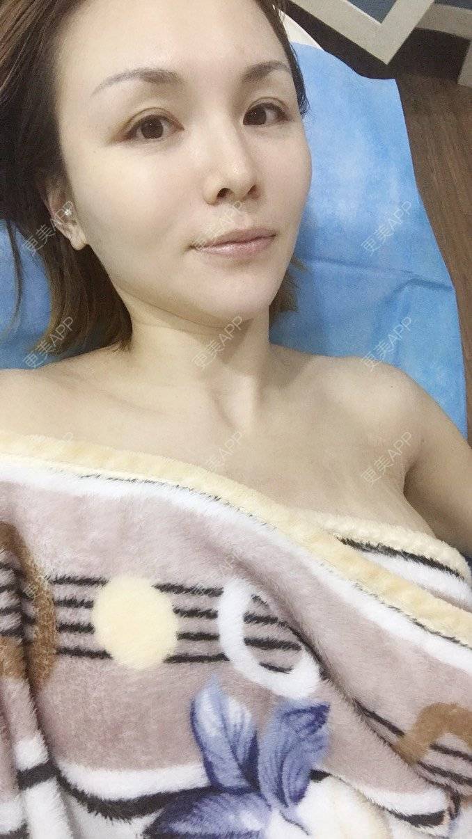 更美 - 小媛0830的假体隆胸经验 | 假体隆胸 | 天津