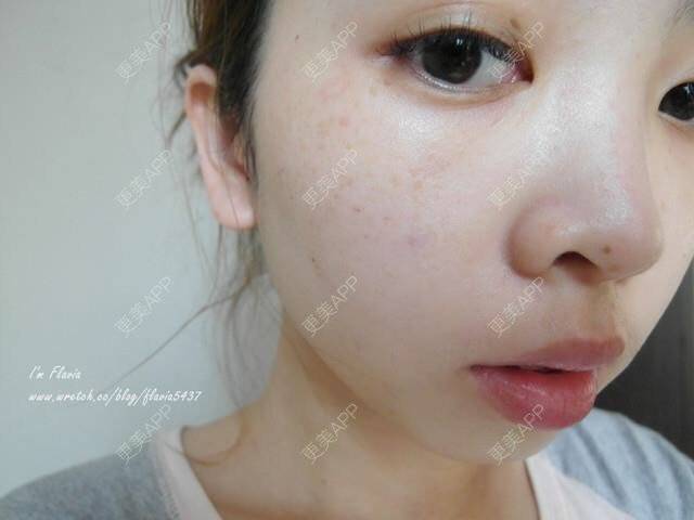 更美 - 星爸比的镭射净肤经验 | 镭射净肤 | 上海