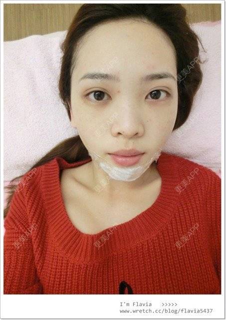 更美 - 星爸比的镭射净肤经验 | 镭射净肤 | 上海