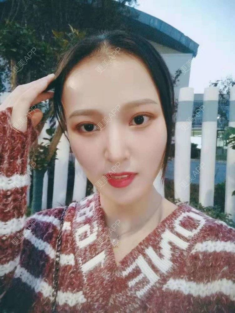 更美 - 勤晴小姐🌿的肋软骨隆鼻经验 | 肋软骨隆鼻 | 隆鼻 | 鼻部综合 | 南京