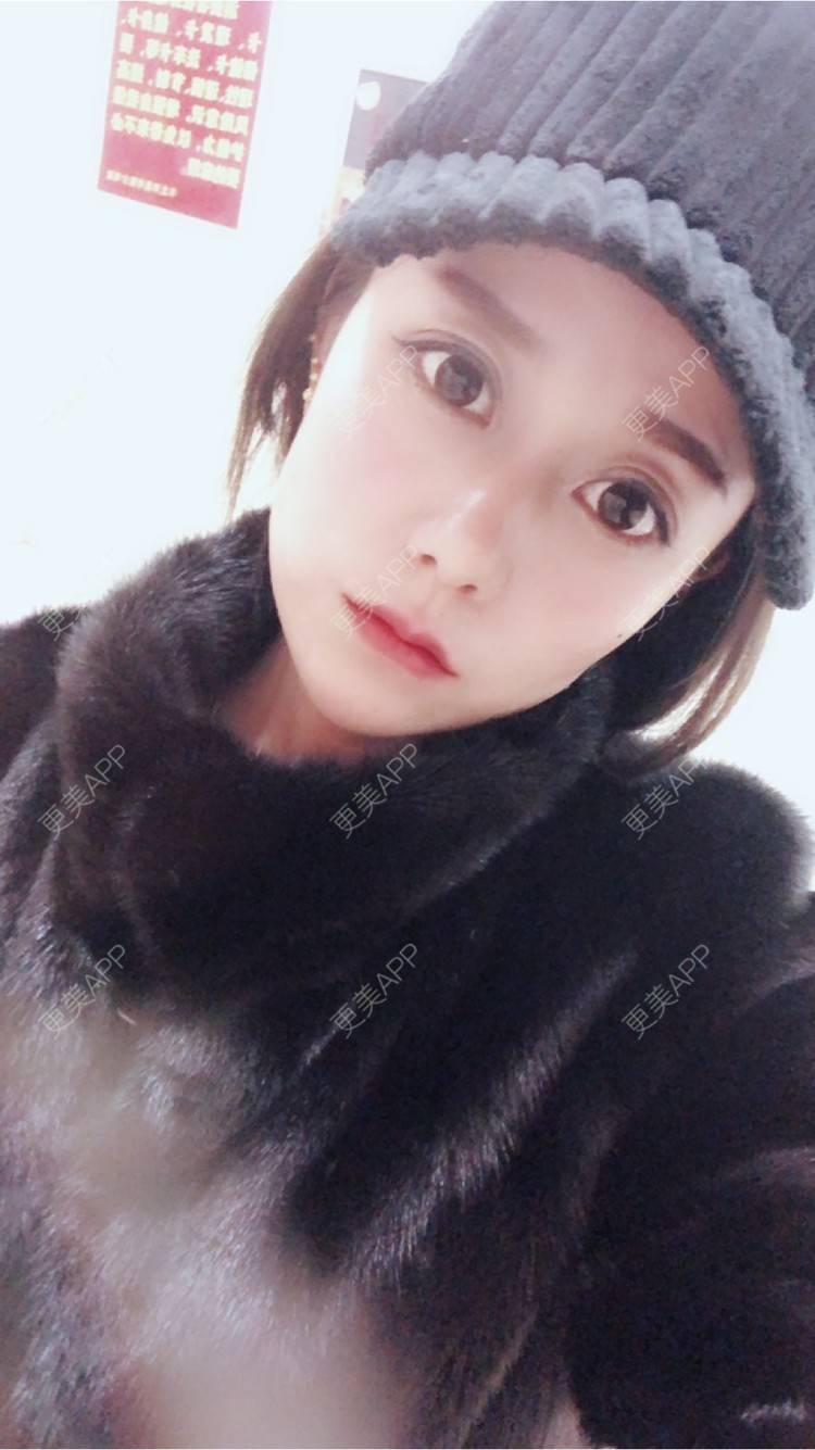 更美 - A  🔥  墨漓的玻尿酸经验 | 长沙 | 两颚 | 北京 | 唇形 | 上海 | 假体隆胸 | 毛发移植 | 南昌 | 深圳 | 吸脂 | 南京 | 玻尿酸 | 成都 | 自体脂肪全面部填充 | 小气泡 | 激光脱毛 | 埋线提升 | 水氧活肤 | 吸脂瘦大腿 | 瘦脸除皱 | 无锡 | 女性私密 | 天津