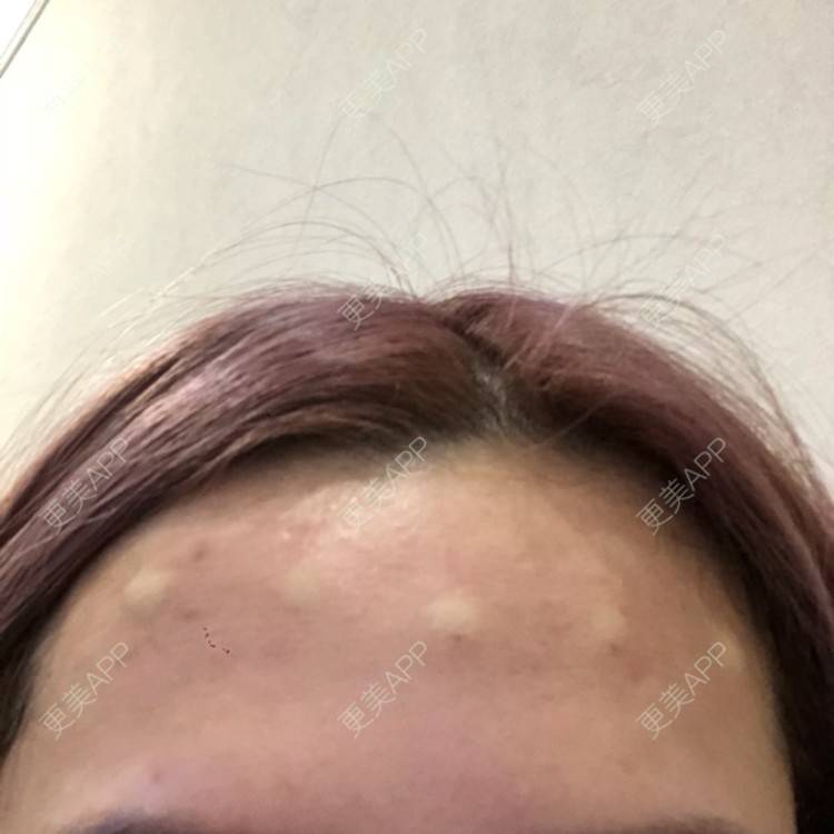 更美 - 欧巴桑💋🙈🤒🤒的除皱瘦脸经验 | 隆胸 | 眼部综合 | 两颚 | 水光项目 | 洗牙套餐 | 双眼皮 | 假体隆胸 | 鼻部综合 | 毛发移植 | 自体脂肪隆胸 | 吸脂 | 玻尿酸 | 埋线提升 | 吸脂瘦大腿 | 瘦脸除皱 | 超声波洗牙 | 注射美白 | 小气泡 | 除皱瘦脸 | 重庆