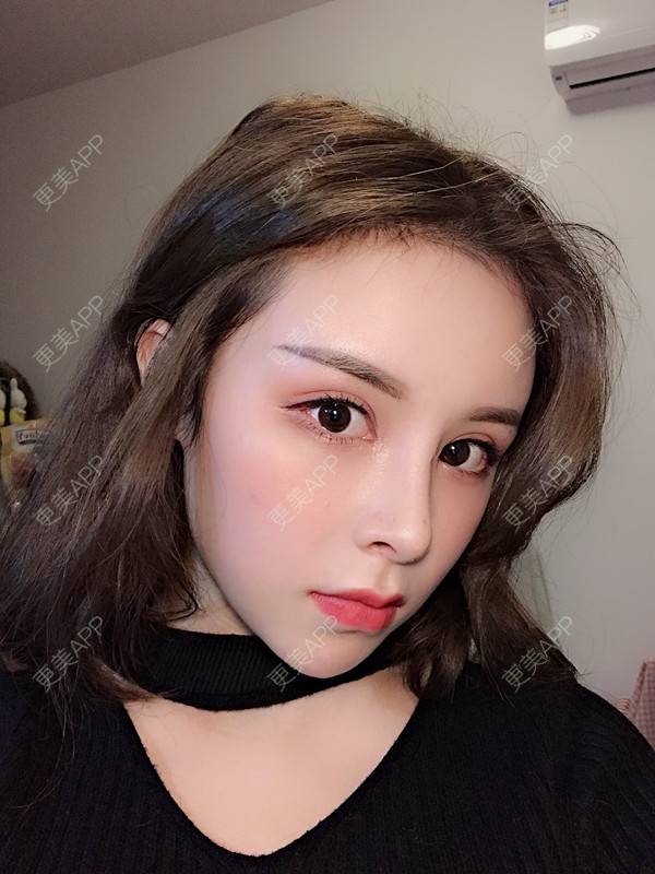 更美 - 一星一一的肋软骨隆鼻日记 | 肋软骨隆鼻 | 隆鼻 | 鼻综合