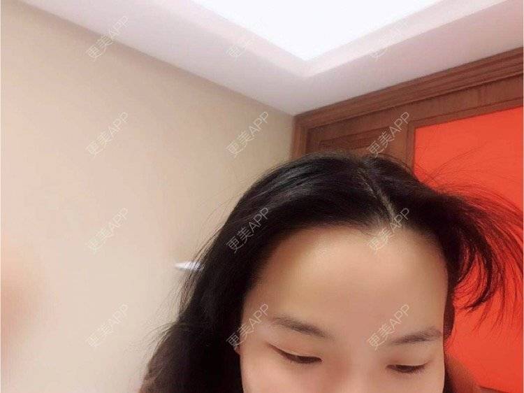 更美 - 哈拉嘿的小气泡经验 | 水光项目 | 超声波洗牙 | 北京 | 淡化皱纹 | 皮肤综合管理套餐 | 双眼皮 | 上海 | 隆鼻 | 毛发移植 | 南昌 | 吸脂 | 南京 | 玻尿酸 | 成都 | 祛疤痕痘印 | 郑州 | 杭州 | 下颌角 | 大连 | 埋线提升 | 舒敏之星 | 除皱瘦脸 | 吸脂瘦脸 | 皮秒激光 | 小气泡 | 东莞