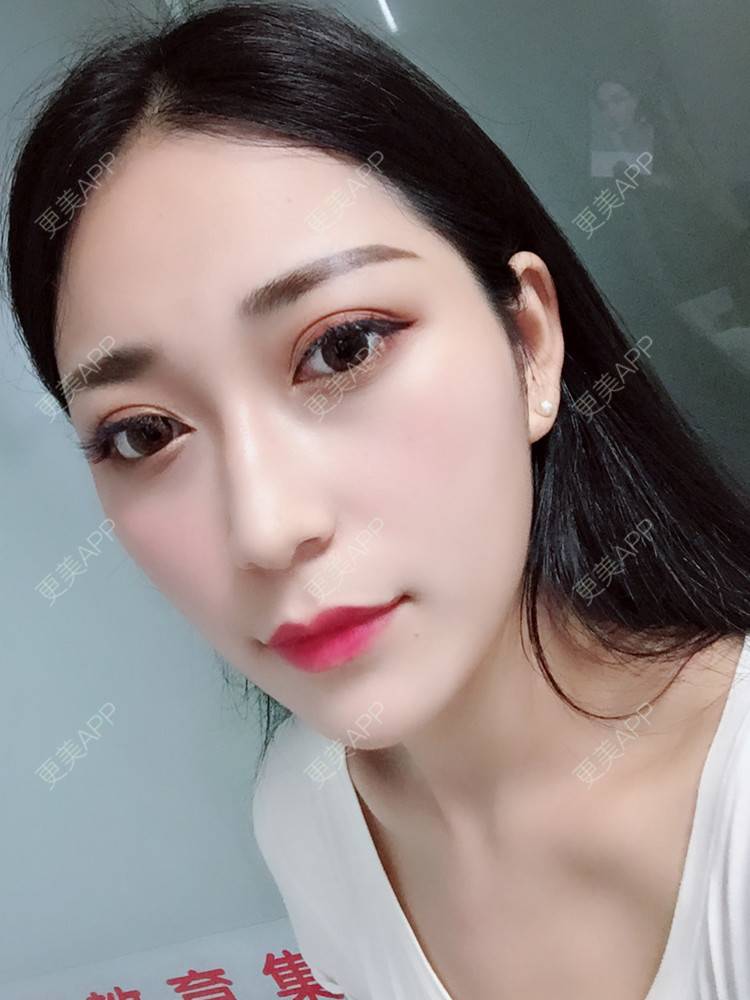 更美 - 肖遥自在的双眼皮日记 | 眼综合 | 视频日记 | 双眼皮