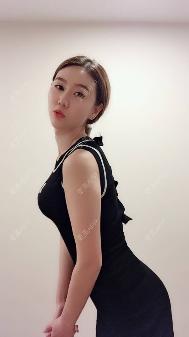 cxebt5w的自体脂肪隆胸日记