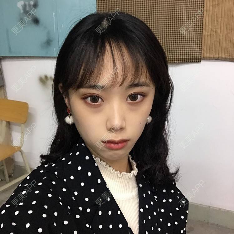 更美 - 王艳 医生的双眼皮经验 | 嘉兴 | 双眼皮